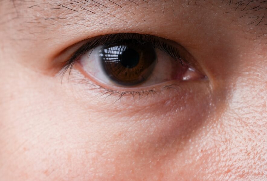 白内障の手術で知っておいた方がいいことの画像